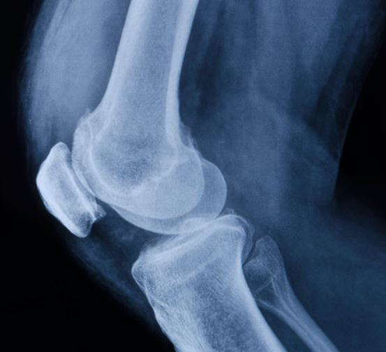 Dieses Bild hat ein leeres alt-Attribut; der Dateiname ist ortema_knie-roentgenaufnahme.jpg.